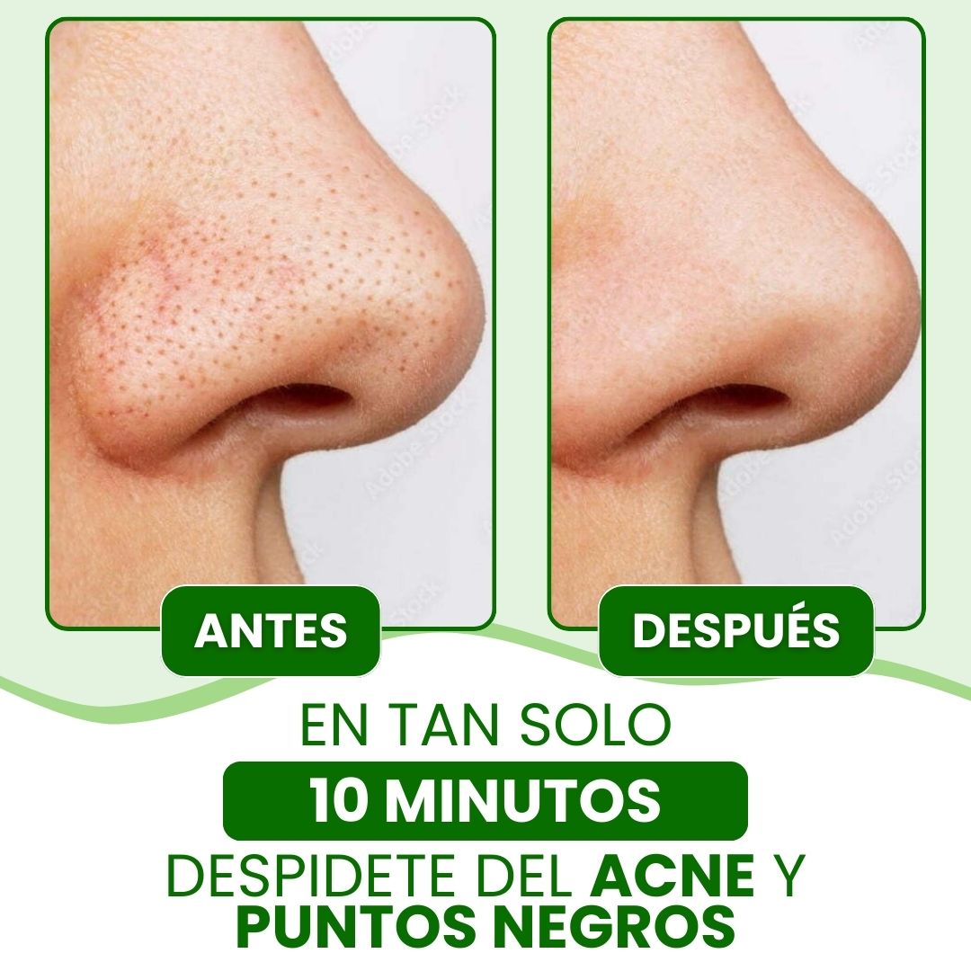 Lanbena: Mascarilla avanzada para puntos negros